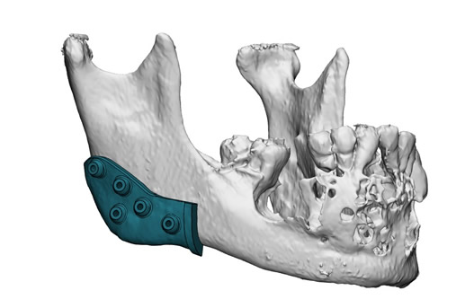 Prótesis Articulación Temporomandibular