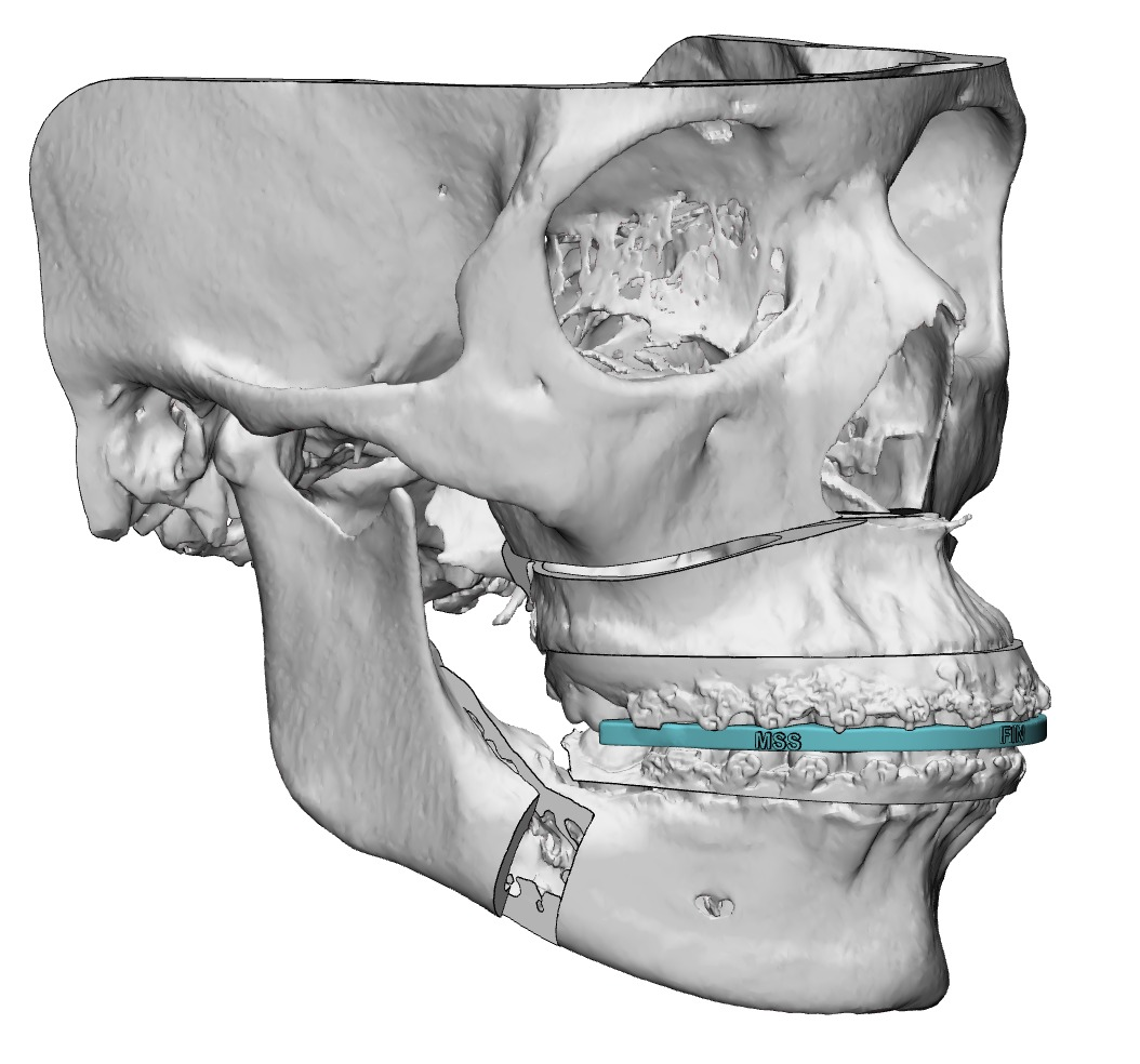 Prótesis Articulación Temporomandibular